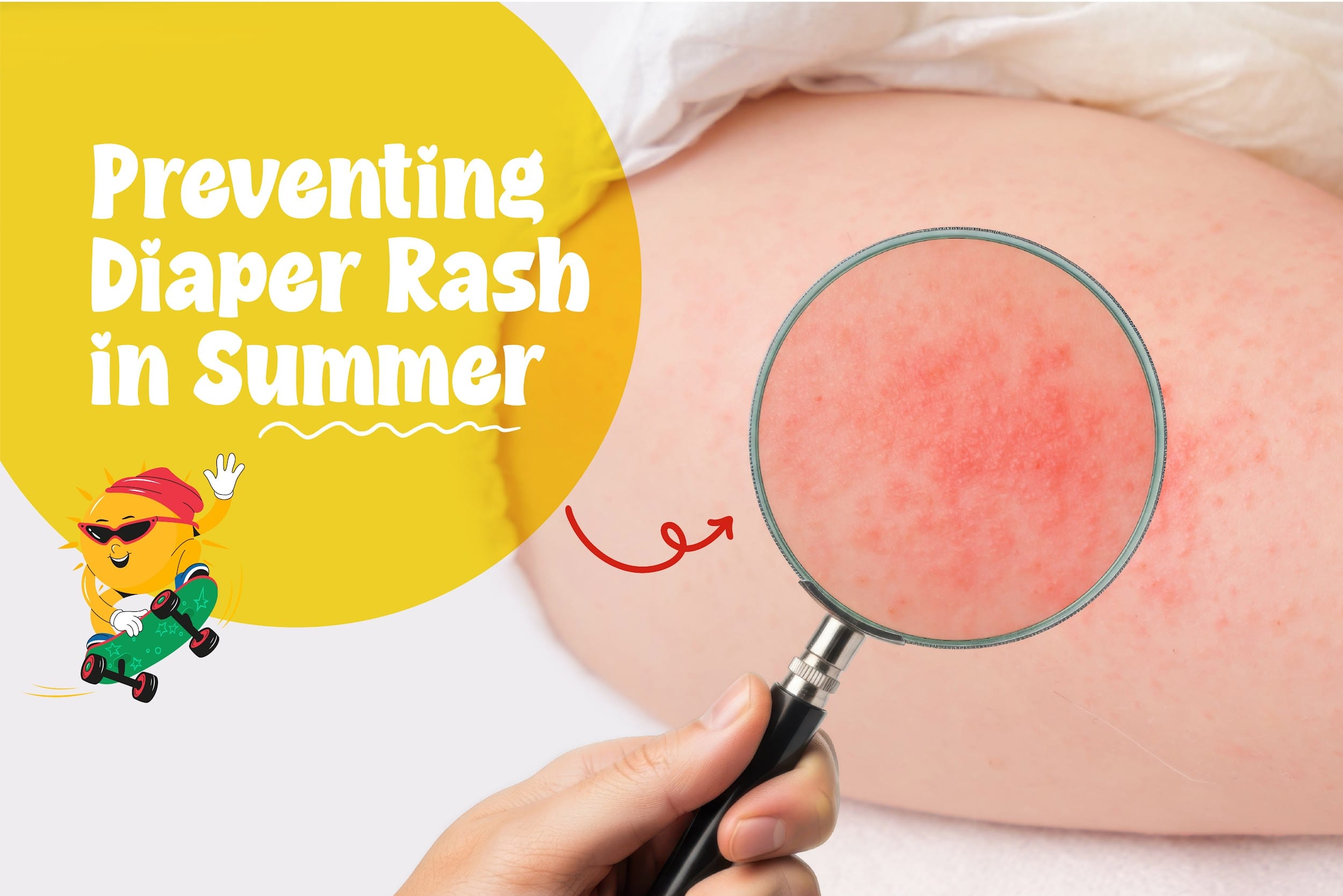 Preventing Diaper Rash in Indian Summer